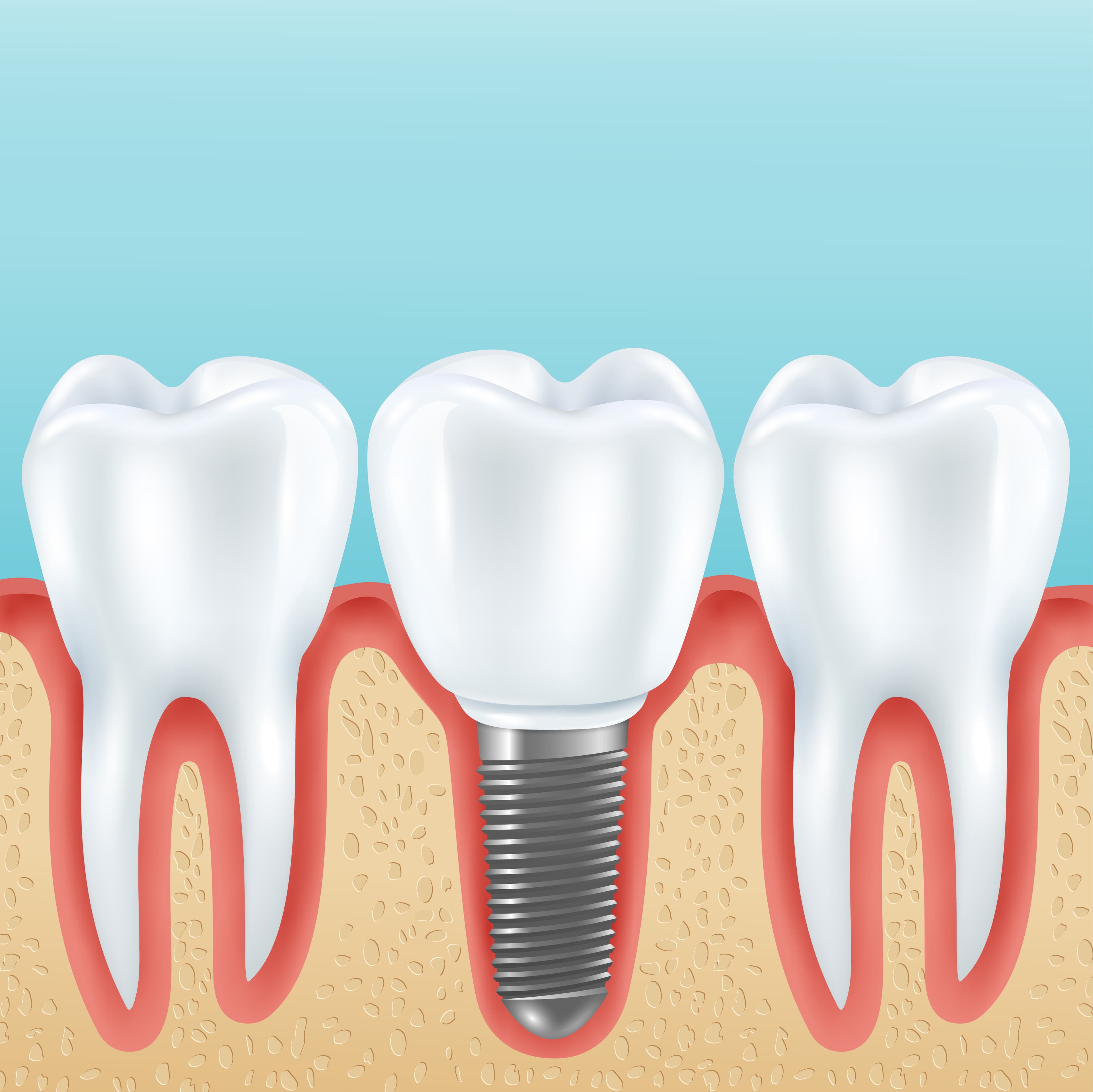 Implants