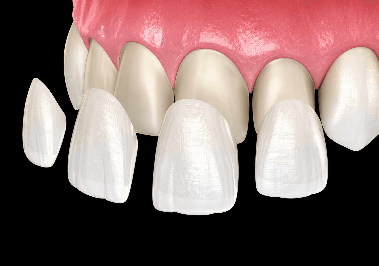 Zirconia Crown and veneers